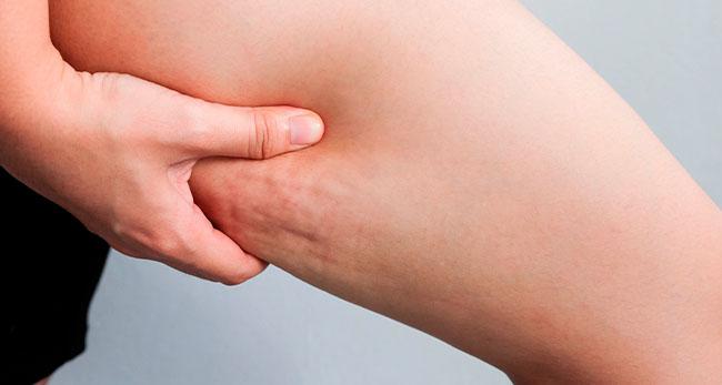 conoce-como-eliminar-la-celulitis