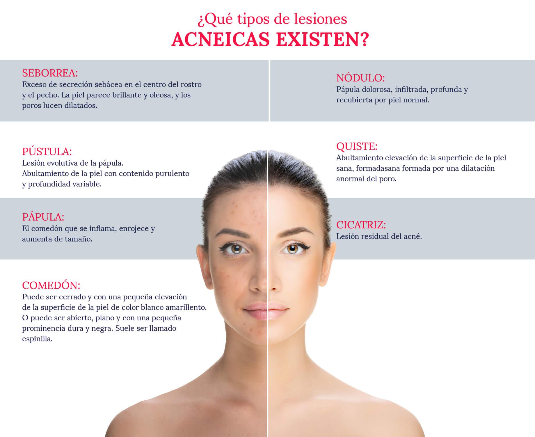 que-tipos-de-lesiones-acneicas-existen