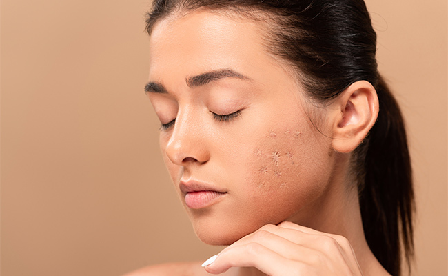 cicatrices-falta-de-colageno